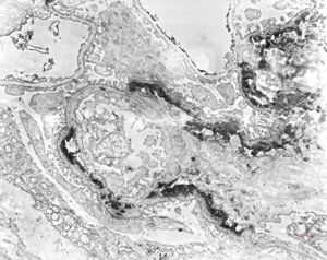 F,15y. | IgA nephropathy … subendothelial deposits